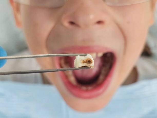 Best Emergency Wisdom Teeth Removal in Middletown, DE